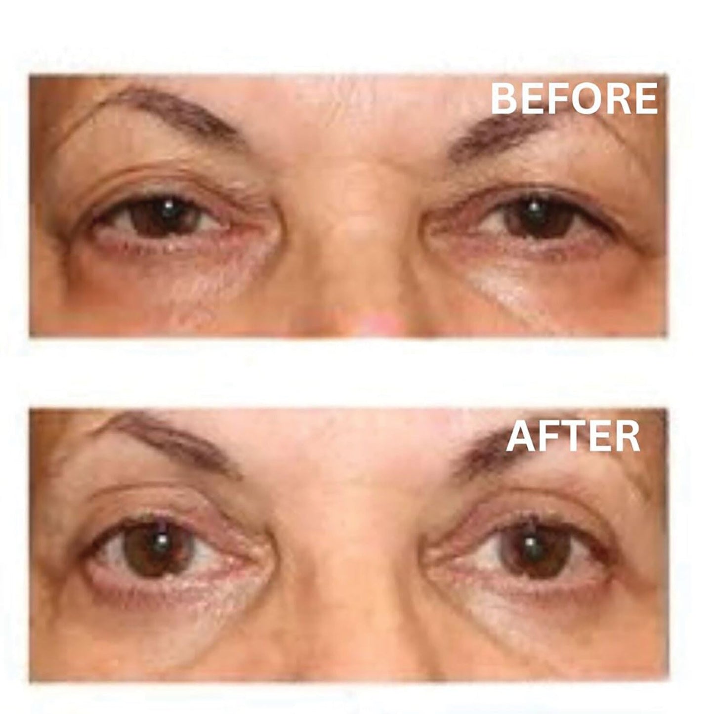 SUPPORT PLUS Eyelid Lifting Cream - Hyaluronic Acid and Caffeine Eye Cream, 1 Oz