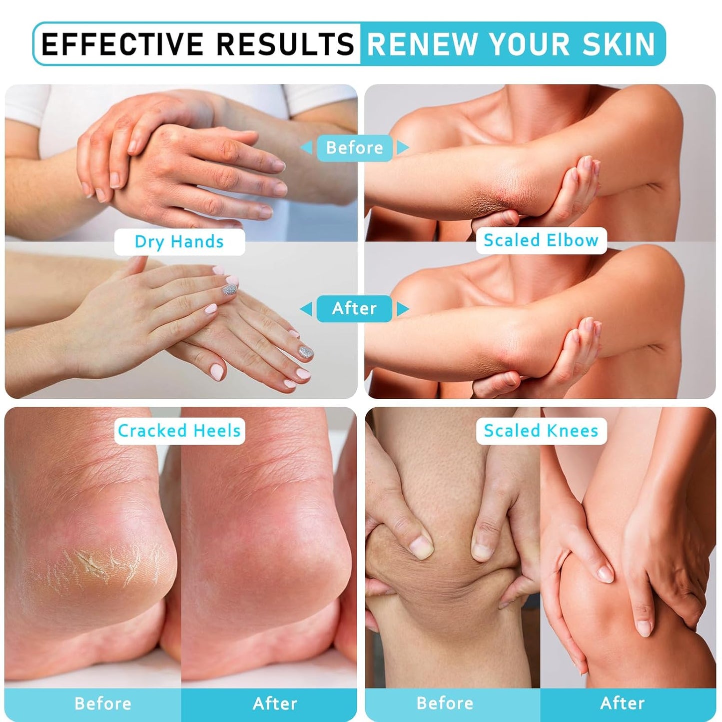 Urea Cream 40 Percent For Feet Maximum Strength - plus Salicylic Acid 2% Foot Cream For Dry Cracked Heels Feet Knees - Dead Skin Cuticle Callus Remover Toenail Softener