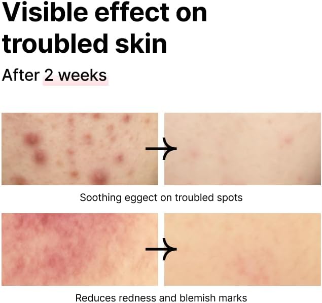 PINKWONDER Tamanu Hero Mineral Salt Essence Toner | All-in-One Blemish Solution | Instant Cooling & Redness Relief | Tamanu Oil & 70+ Minerals for Skin Balance (150ml / 5.07 fl. oz.)