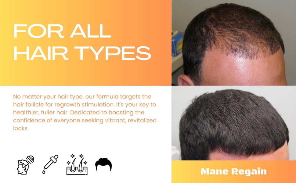 Minoxidil Topical Solution USP 5%, Extra Strength Hair Regrowth Treatment for Men, 2 Month Supply, Unscented, 4 Fl Oz (2 Pack)