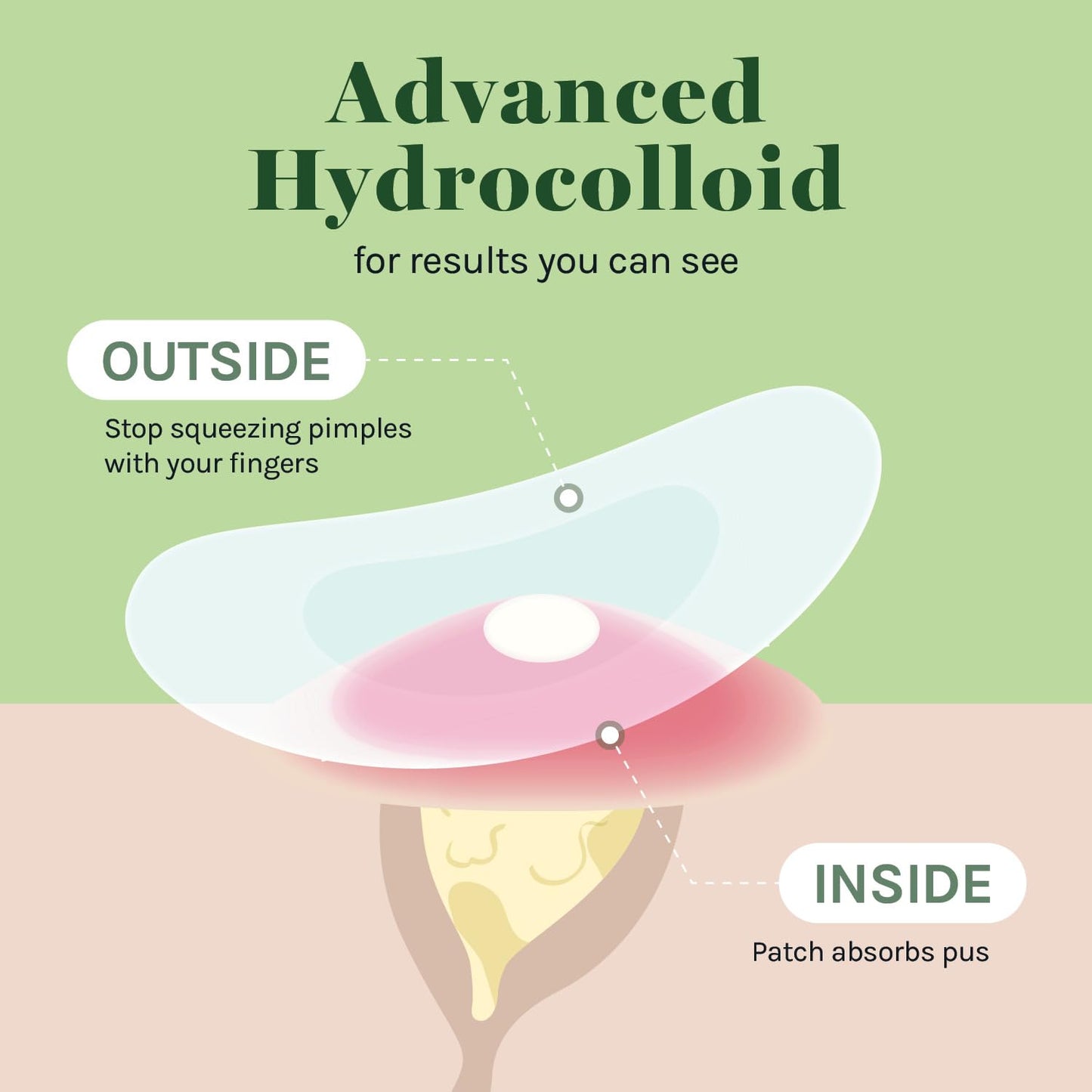 AOA Studio Absorbing Cover Healing Invisible Acne Patch Blemish Spot, Treatment, Facial Acne Patch Vegan, Cruelty Free, Hydrocolloid, Two Sizes 10mm 12mm (Total 84 Counts)