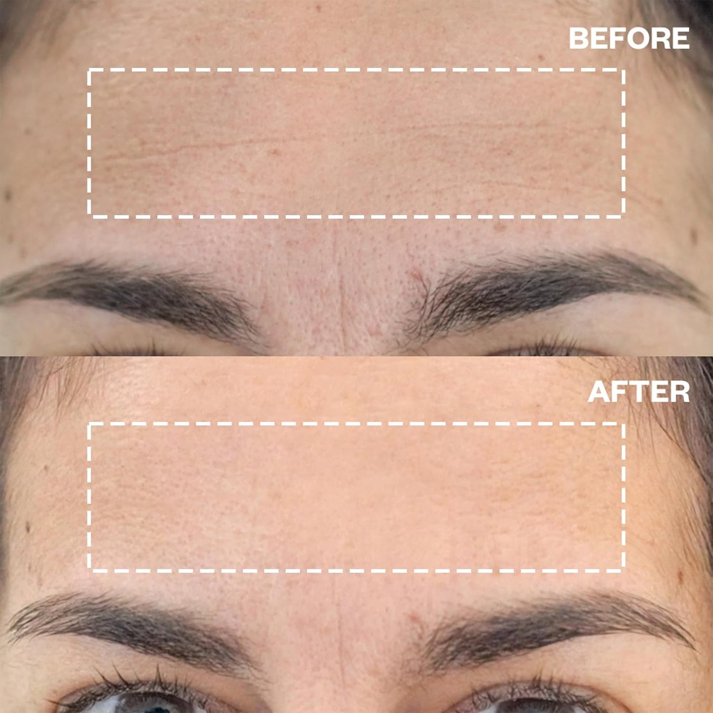 Wrinkles Schminkles Forehead Wrinkle Patches - Reusable Silicone Smoothing Pads for Brow Lift, Wrinkle Smoothers, Reduce Frown Lines & Face Lift (2 Pack)