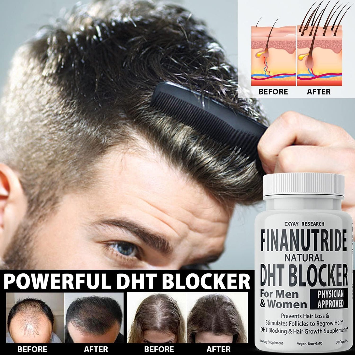 Finanutride Natural DHT Blocker & Hair Growth Capsules - Prevent Hair Loss, Stimulate Follicles, Proprietary Regrowth Treatment