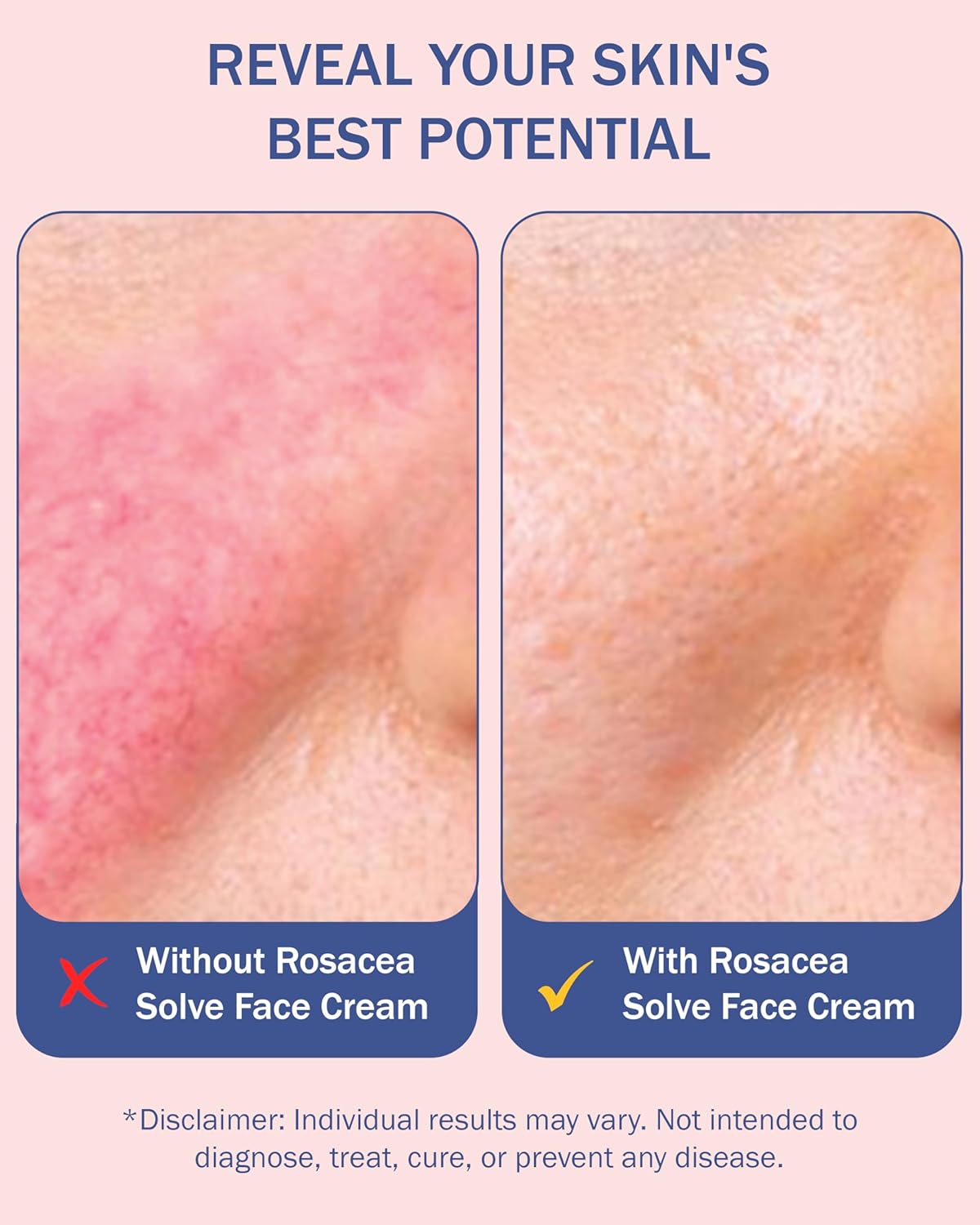 Rosacea Treatment for Face Skincare Cream for Women & Men (Pack of 2) - Gentle Moisturizer Redness Reducing Skin Care - with Aloe Vera & Hyaluronic Acid - Day-Night, Made in USA by e70 (2.25 fl. oz.)