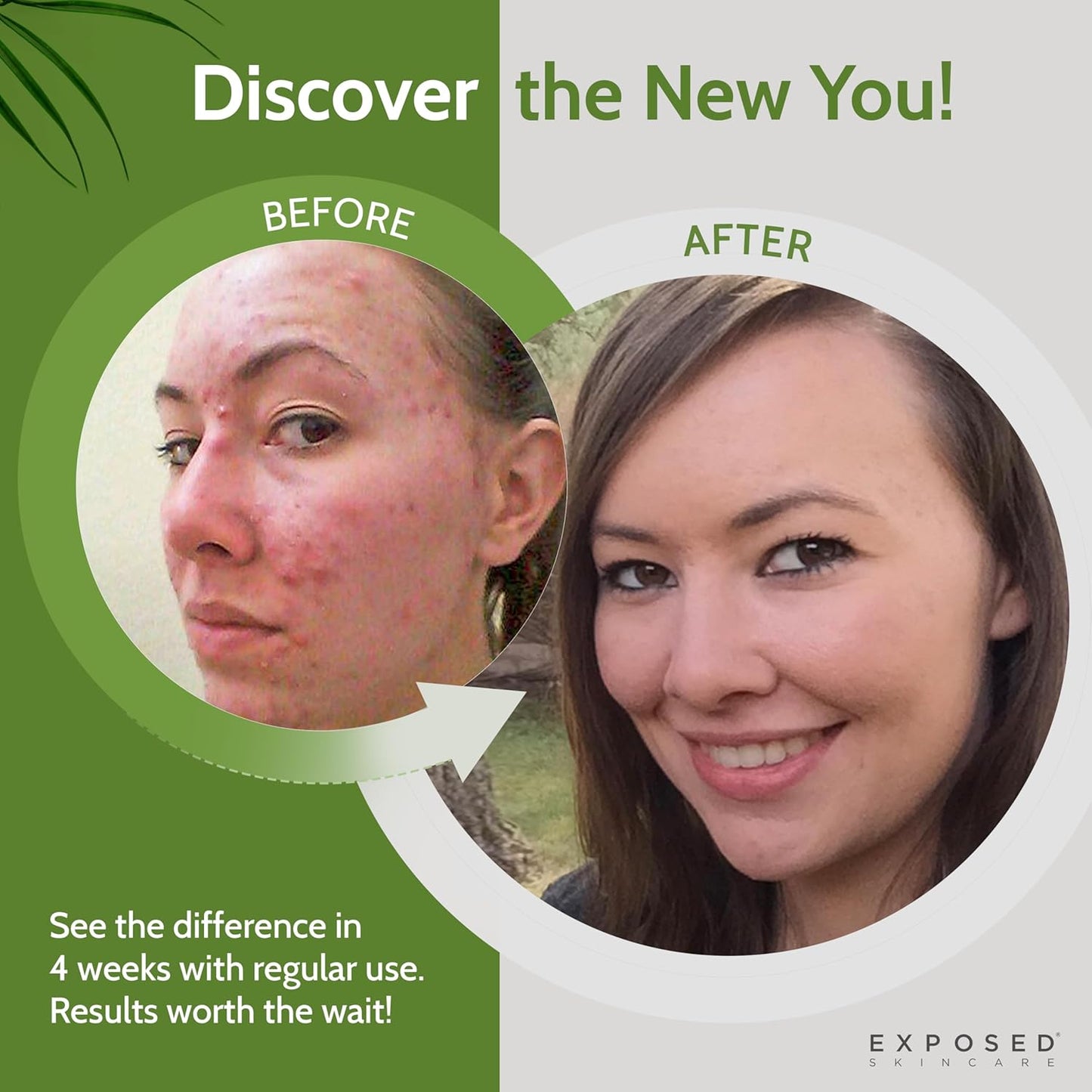 Exposed Skin Care Clearing Tonic Facial Toner with 1% Salicylic Acid and Witch Hazel for Acne Treatment – Pore Minimizing Toner to Prevent Breakouts, Reduce Redness and Balance Skin – Step 2 (4 fl oz)