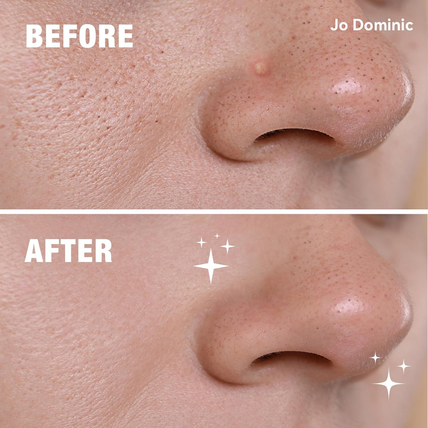 MAGIX PATCH Nose & Chin Pimple Patches Hydrocolloid Acne Patches for T-Zone Care – Absorbs Oil, Zits & Blemishes Overnight – Vegan, Cruelty-Free Skincare (15 Count)