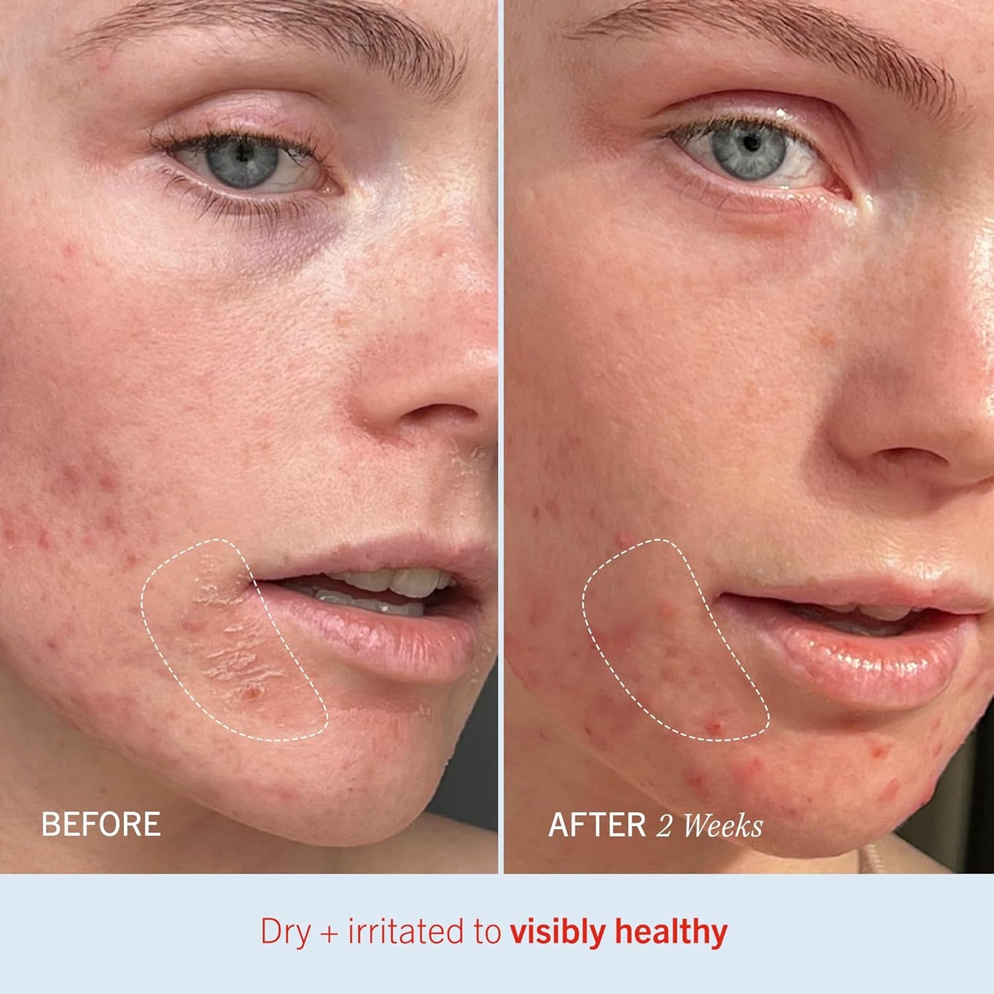 First Aid Beauty - Ultra Repair Cream, Intense Hydration Whipped Colloidal Oatmeal, Clinically Proven to Strengthen Skin Barrier in 7 Days + Helps Relieve Eczema, Luxury Moisturizer (6oz, 2ct)