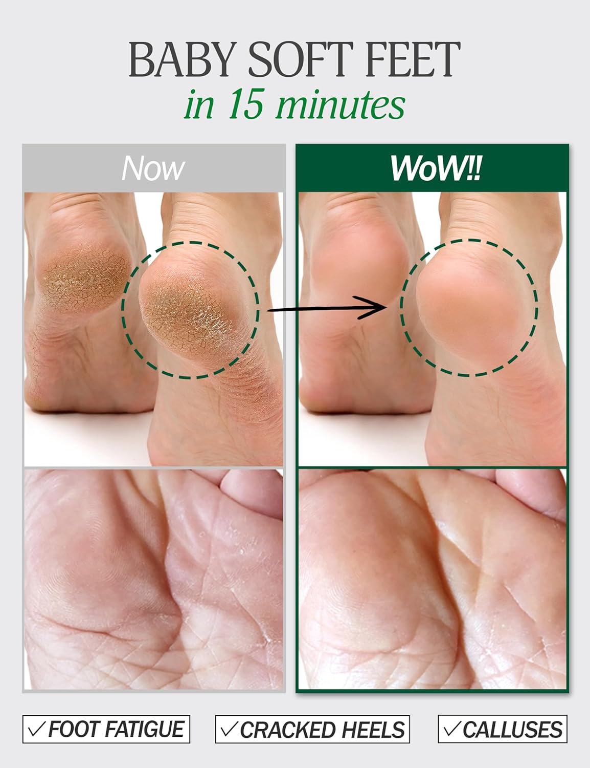 Moisturizing Foot Mask for Dry Cracked Feet | Hydrating at Home Foot Spa Kit Baby Feet Foot Peel Cracked Heel Repair w/Natural Ingredients | No More Dry Rough Calloused Feet (5 Pairs)