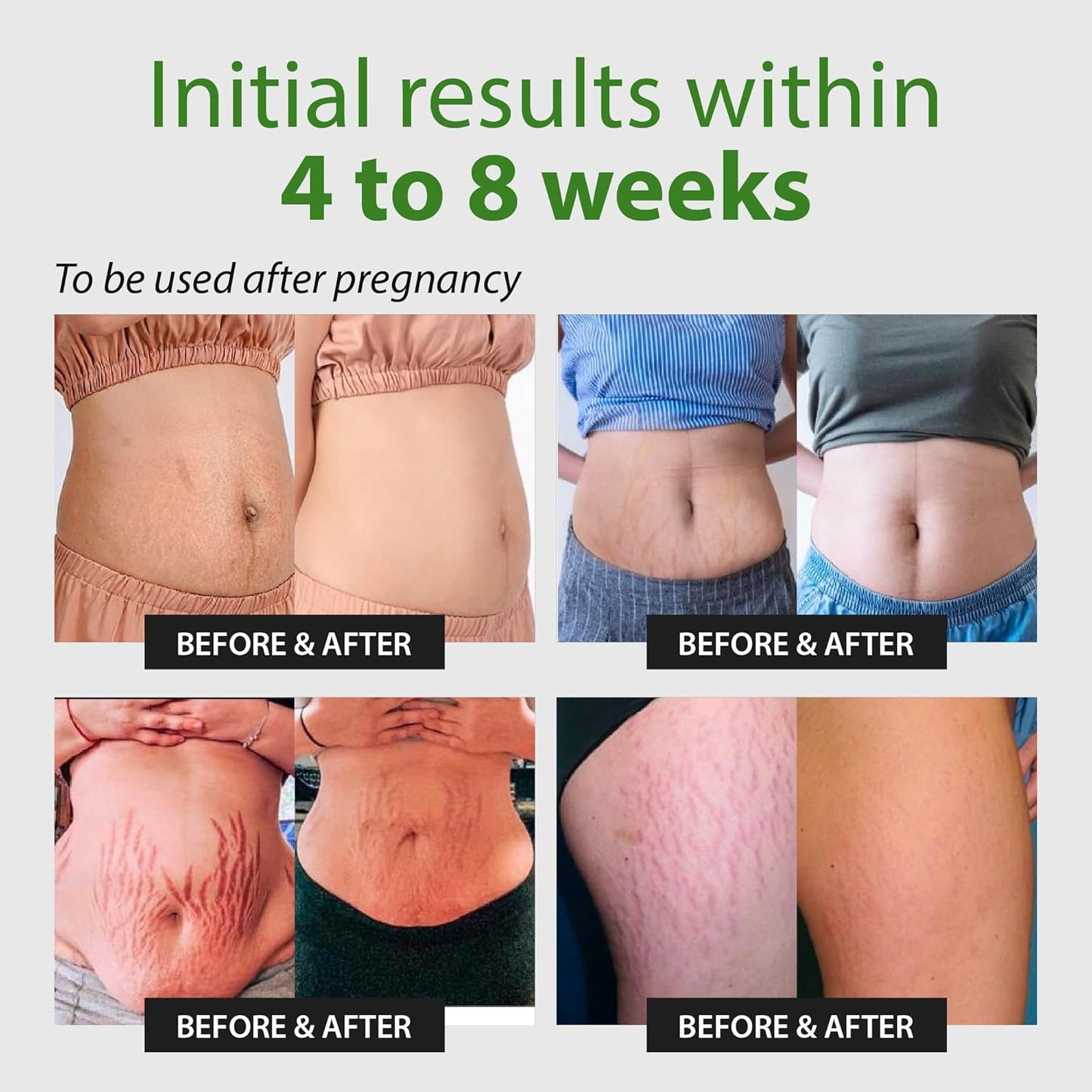 Abera Ovela Maternity Stretch Mark Cream with Eye Mask for Pregnancy and Weight Fluctuations, Stretch Mark Treatment Pregnancy Must Haves, Deep Stretch Mark Removal, All Skin Types, 1.69 fl oz